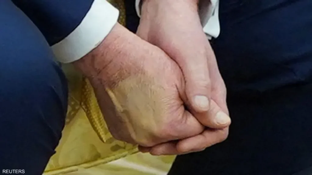 كدمة غريبة على يد ترامب تثير الجدل رغم تفسير البيت الأبيض